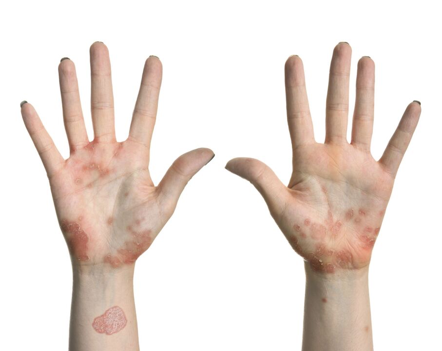 Premiers symptômes du psoriasis