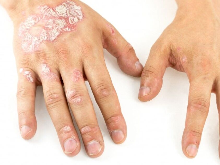 Psoriasis sur les mains